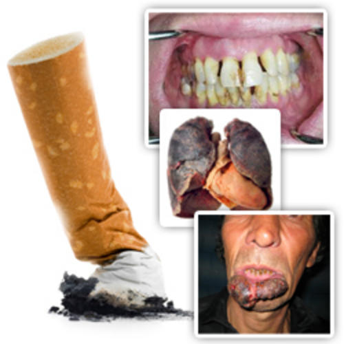 296957_120619132644_smoking-diseases